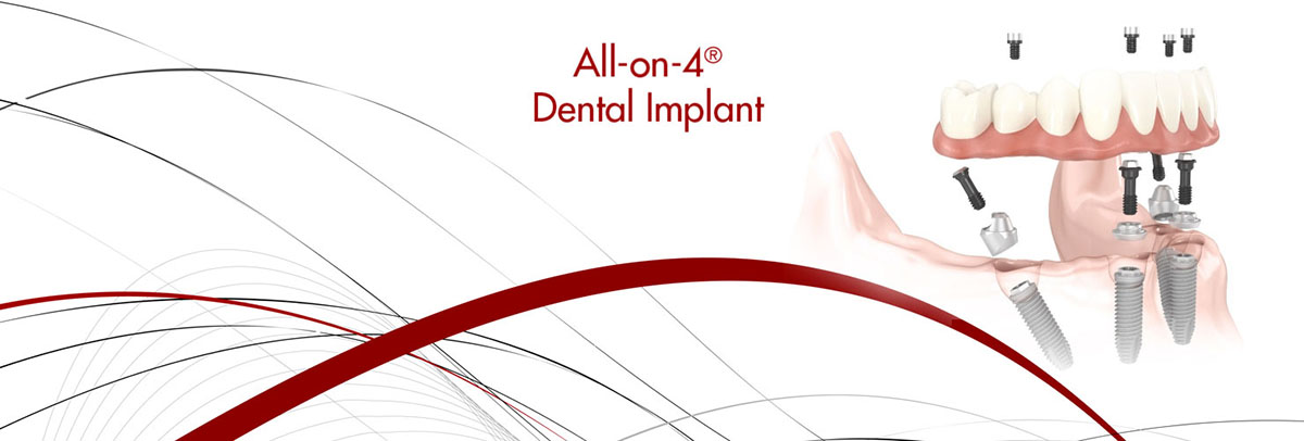 Solvang All-on-4 Dental Implants