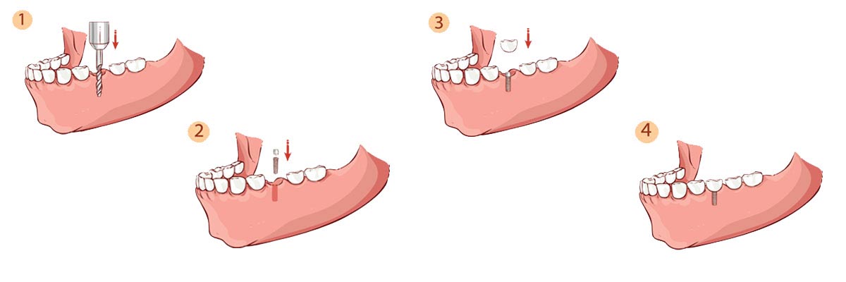 Solvang The Dental Implant Procedure