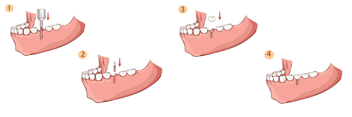 Solvang Dental Implant Restoration