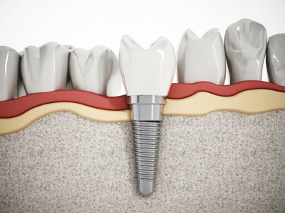 We Specialize In Placing Dental Implants