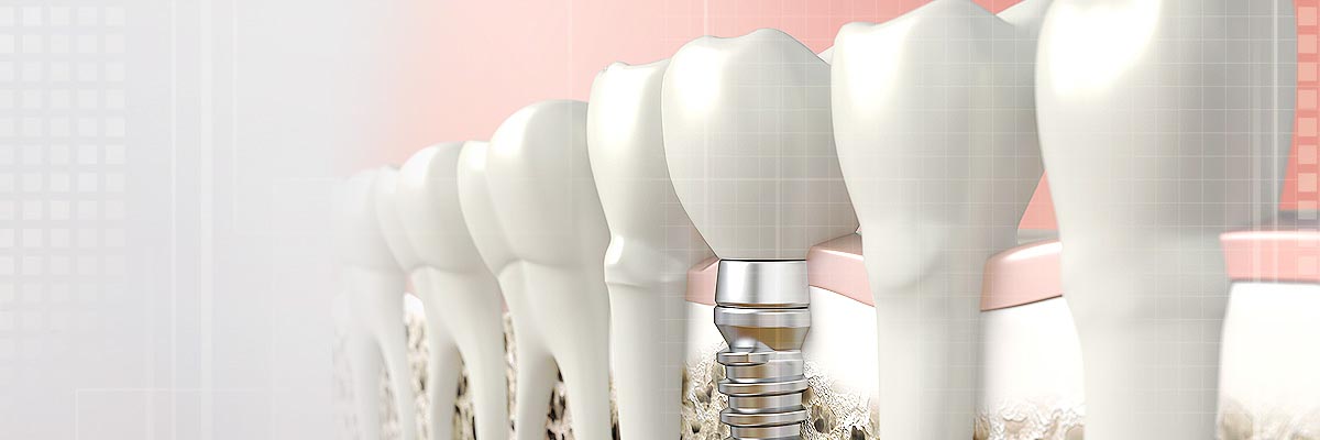 Solvang Implant Dentist