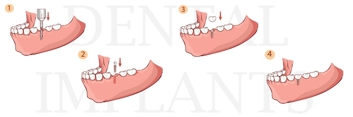 Solvang The Difference Between Dental Implants and Mini Dental Implants