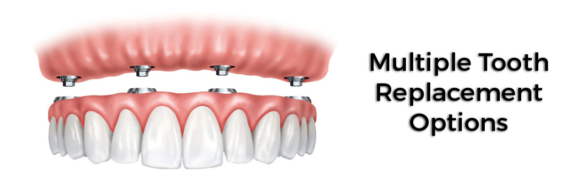 Solvang Multiple Teeth Replacement Options