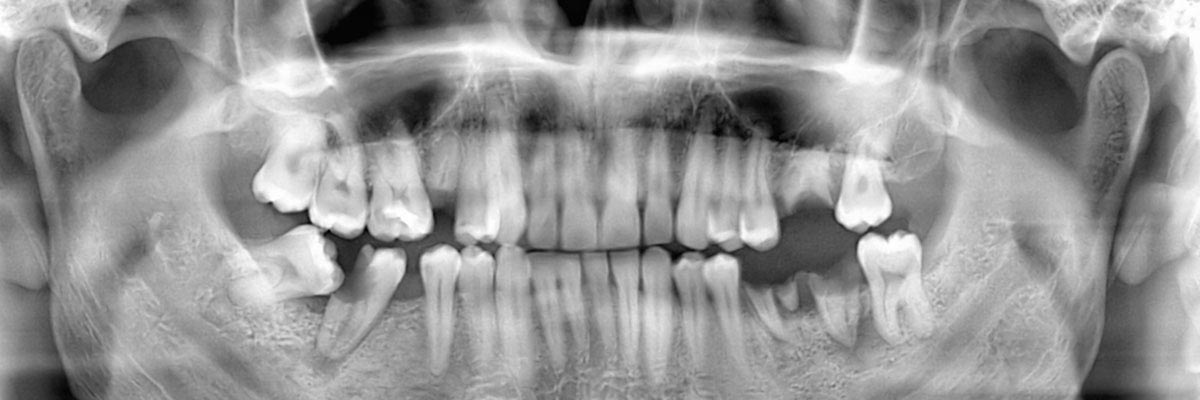 Solvang Options for Replacing Missing Teeth